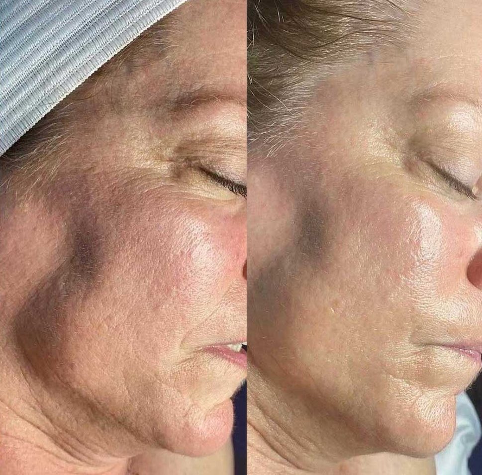 Before and after results — Mature skin facial at Blessed Beauty Spa, Surrey BC
