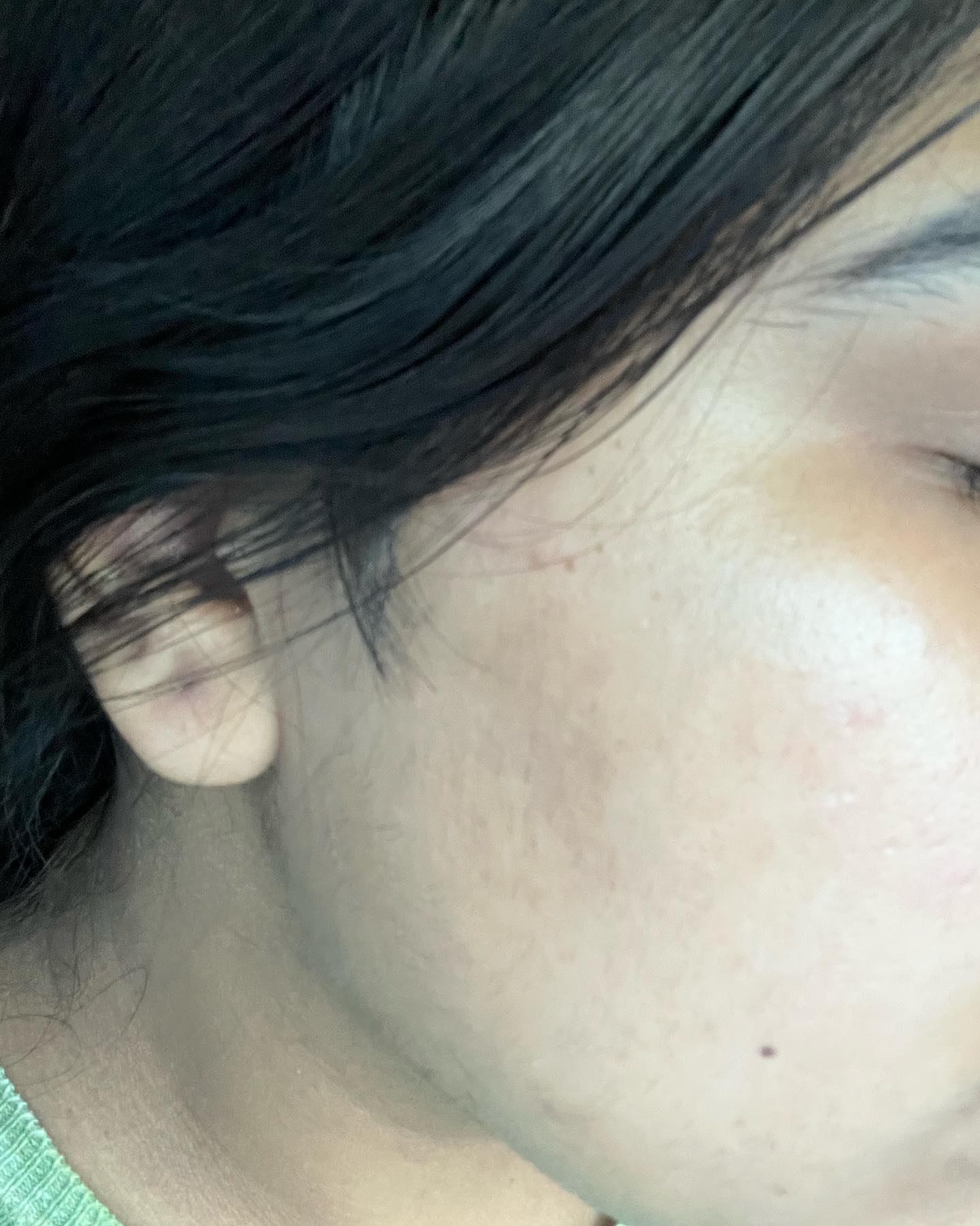Before and after results — Rejuvenated cheek area at Blessed Beauty Spa, Surrey BC
