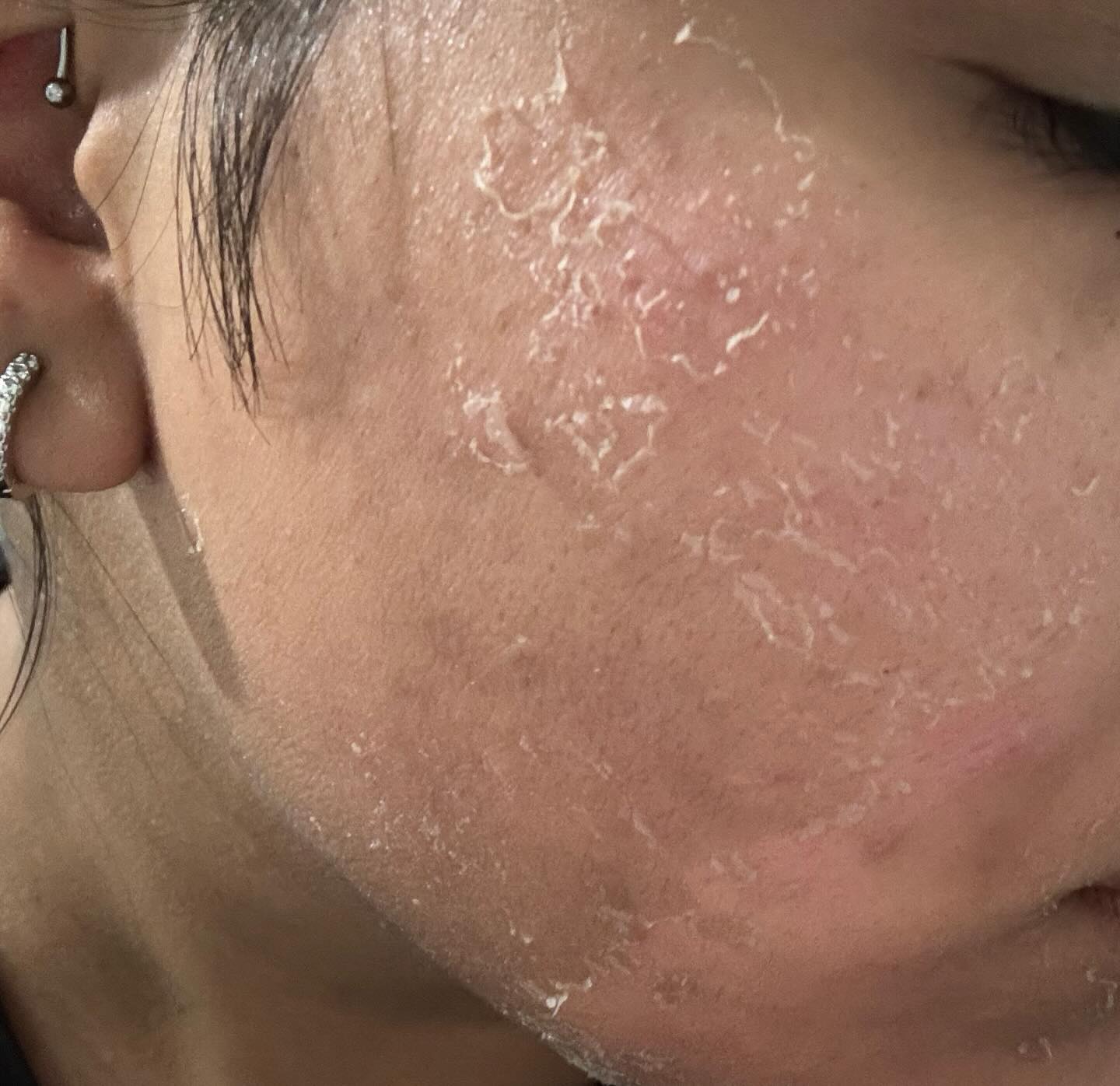 Before and after results — Skin renewal after a facial at Blessed Beauty Spa, Surrey BC