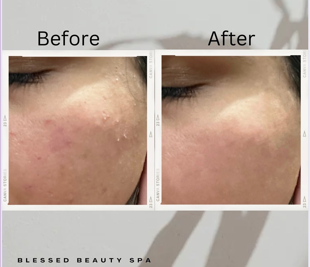 Before and after results — Acne texture — facial treatment at Blessed Beauty Spa, Surrey BC