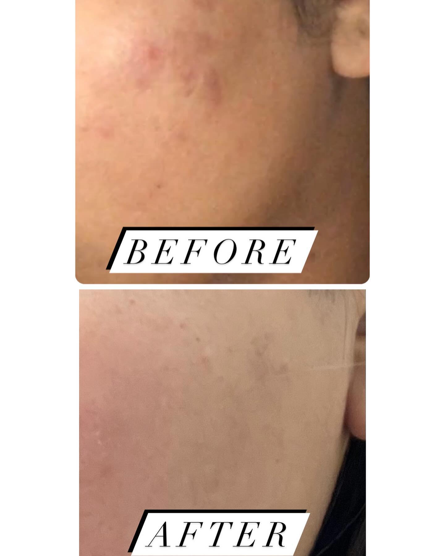 Before and after results — Acne marks at Blessed Beauty Spa, Surrey BC