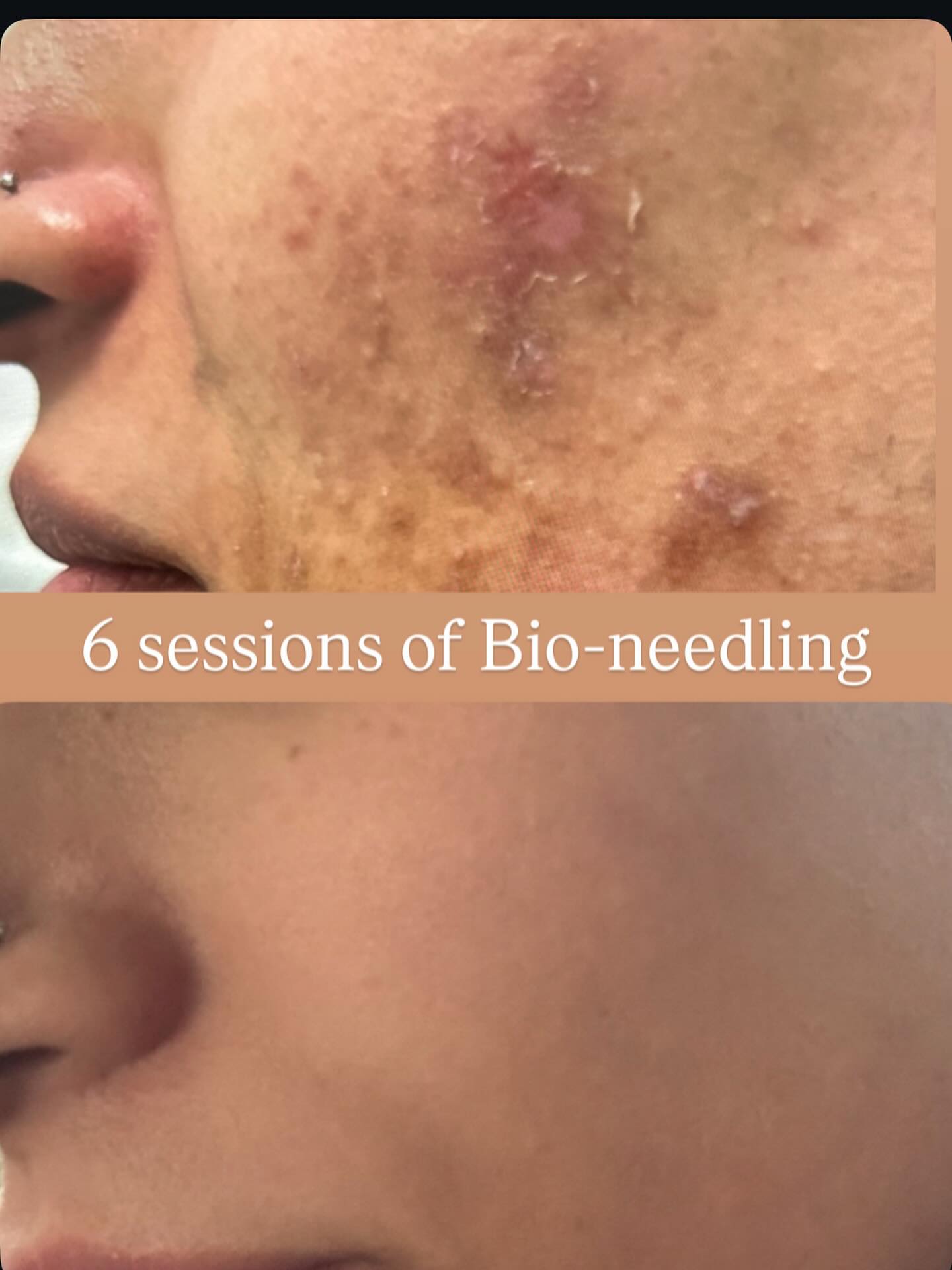 Before and after results — Bio-needling — 6 sessions at Blessed Beauty Spa, Surrey BC