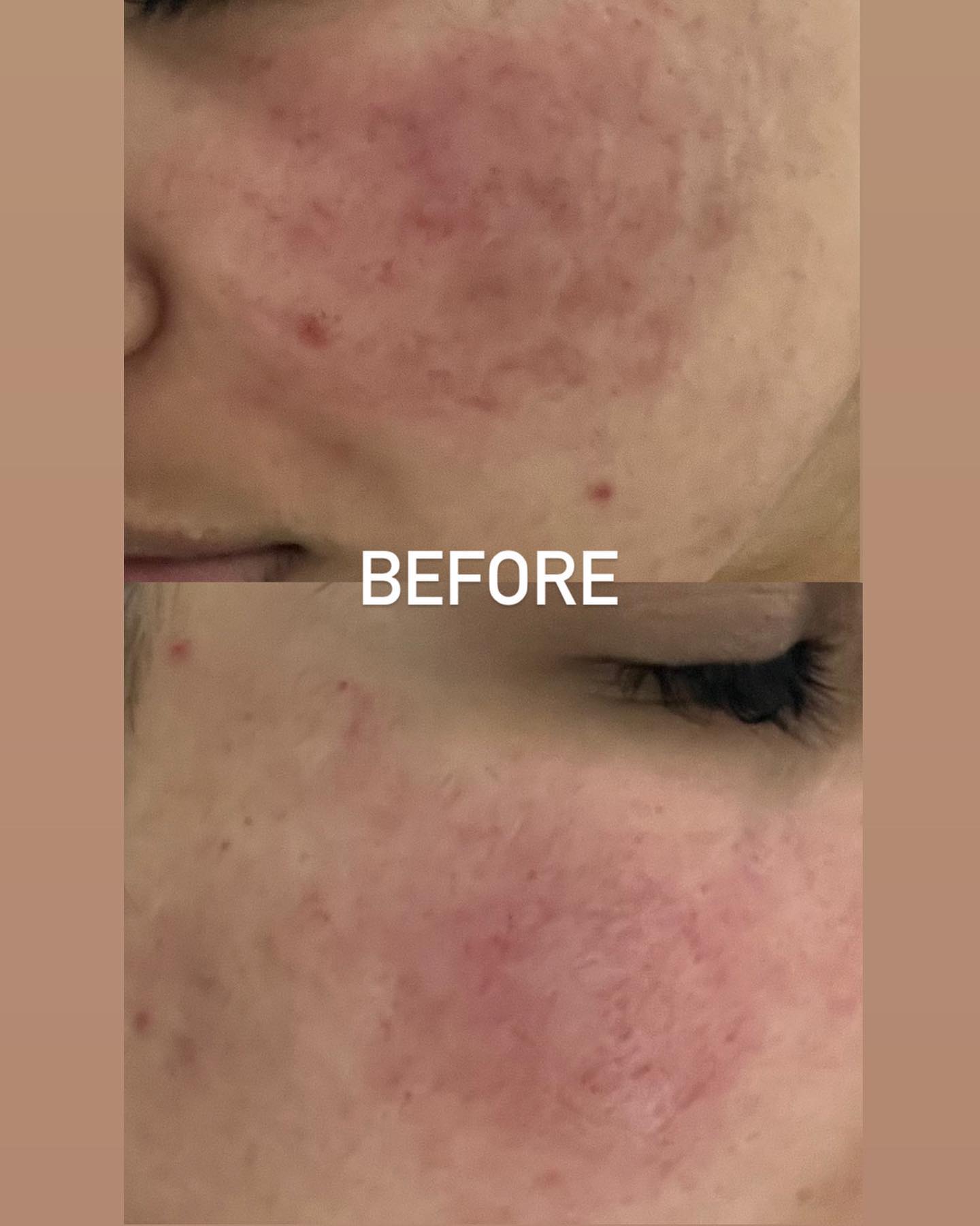 Before and after results — Acne — skin improvement at Blessed Beauty Spa, Surrey BC