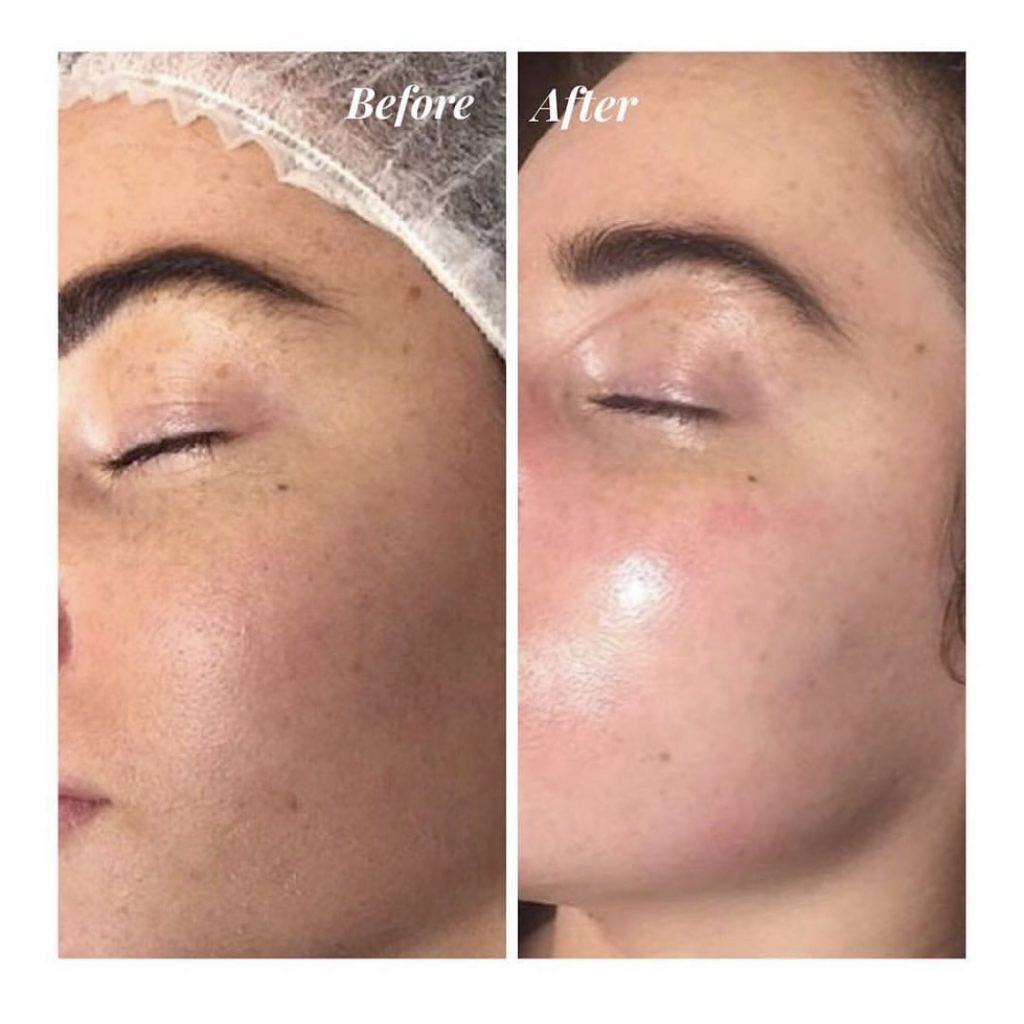 Before and after results — Skin rejuvenation facial at Blessed Beauty Spa, Surrey BC