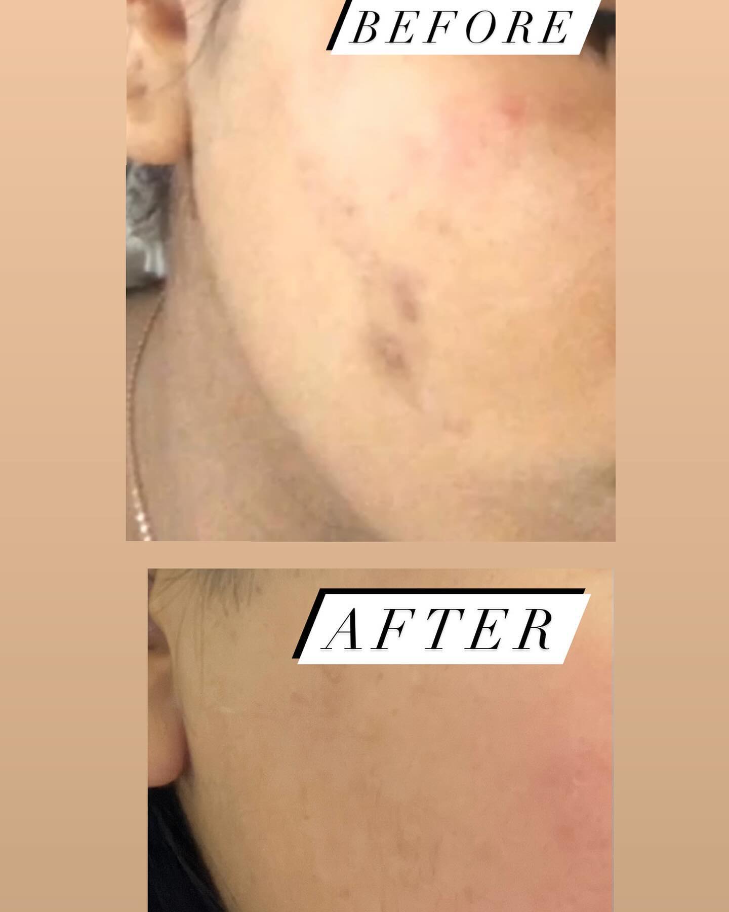 Before and after results — Skin texture at Blessed Beauty Spa, Surrey BC